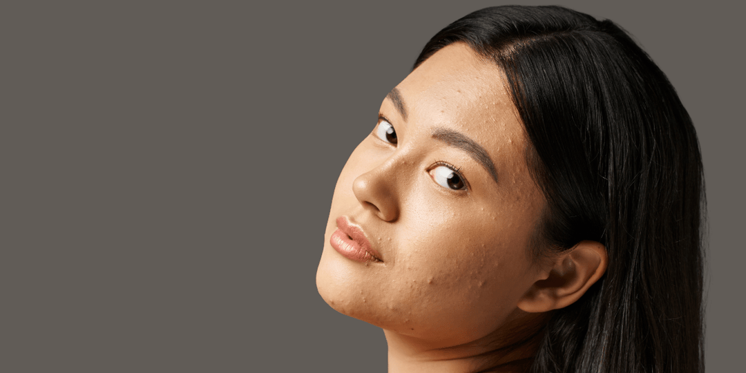 Acne-Prone Skin - Rajan Dermatology